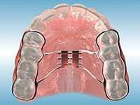 palatal expander model