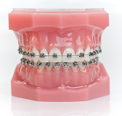 self-ligating braces