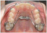 palatal expander model